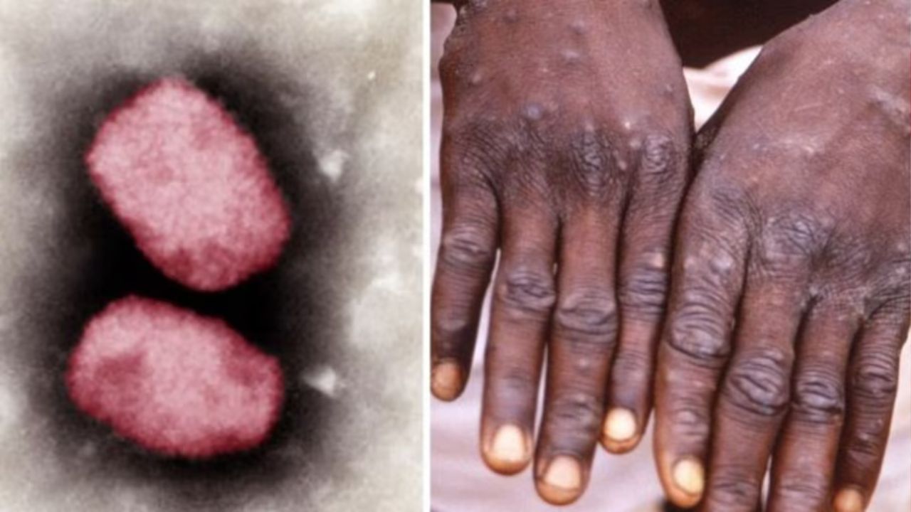 Monkeypox threat in India: विदेश से लौटे युवक में मंकी पॉक्स के लक्षण पाए गए, आइसोलेशन में रखा गया